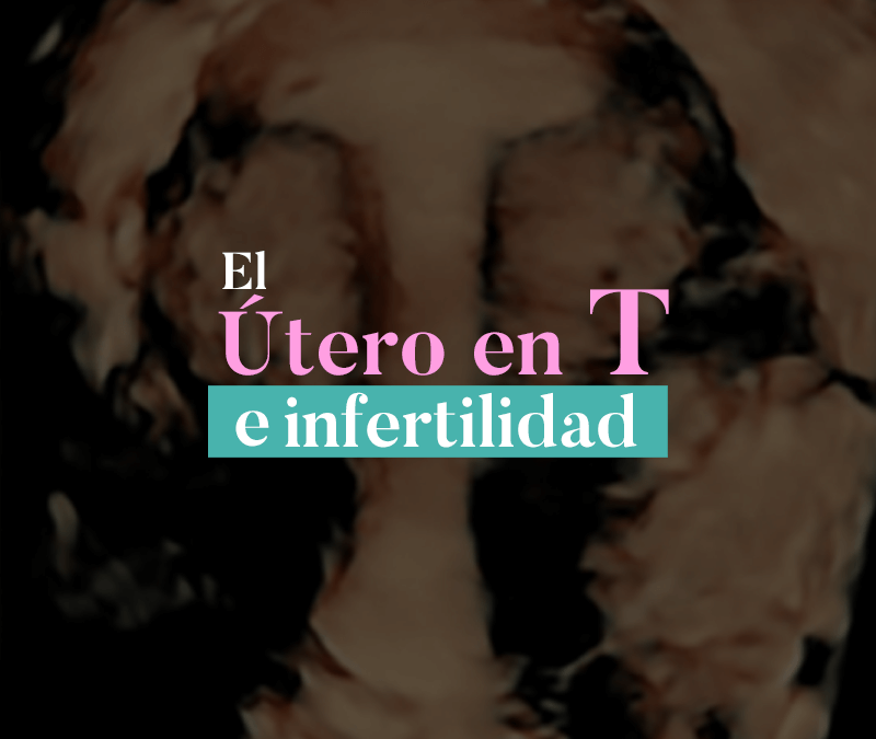 EL ÚTERO EN “T” E INFERTILIDAD