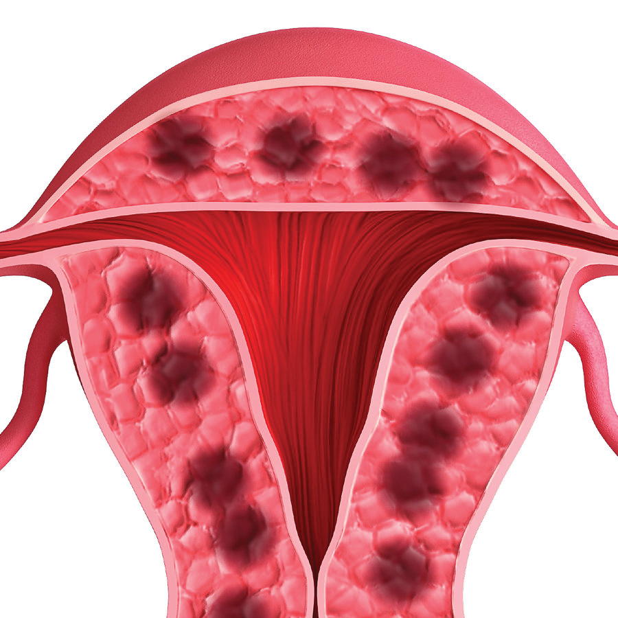 Tratamiento De Adenomiosis En Lima